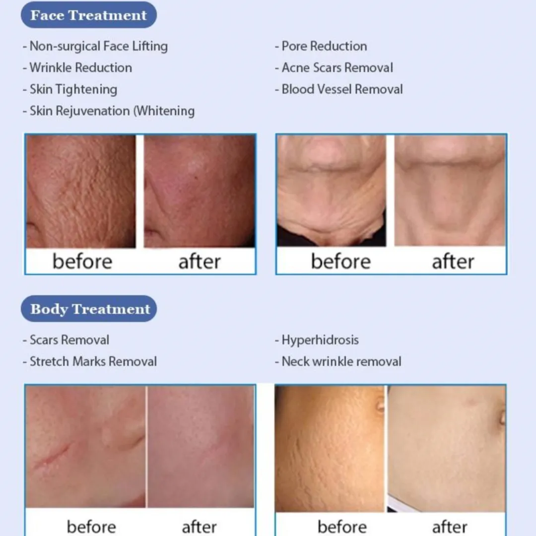 Goldskin Elite Radiofrequency Microneedling & Fractional RF